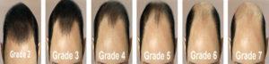 Norwood Grading of Baldness