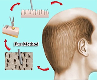 what is fue hair transplant technique