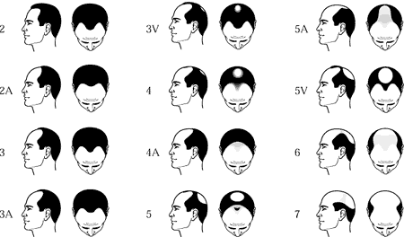 hair loss grading norwood navdeep hair transplant