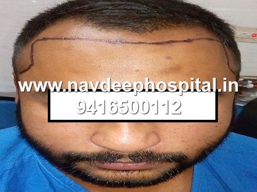 Before FUE hair transplant at Navdeep Hair transplant and LASER Clinic, Panipat, Haryana, India