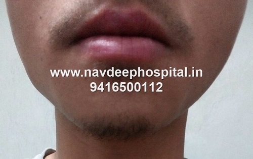 Before FUE hair transplant for beard at Navdeep hair hospital and laser center, Panipat, Haryana, India