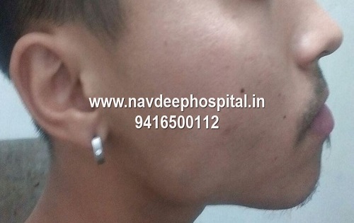 Before FUE hair transplant for beard at Navdeep hair hospital and laser center, Panipat, Haryana, India