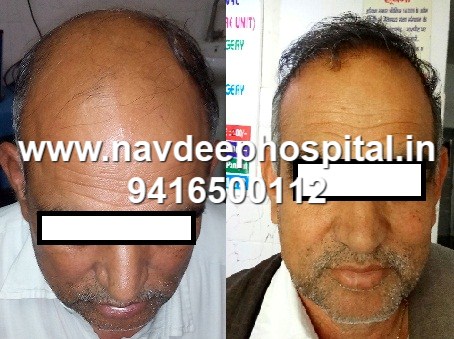 Before after result of fue hair transplant in Navdeep hospital, Panipat, Haryana, India. Client from hisar