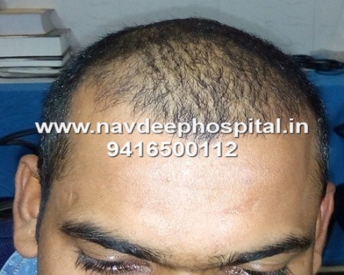 Before hair transplant, Navdeep hair transplant center and Laser clinic, Panipat, Haryana, India