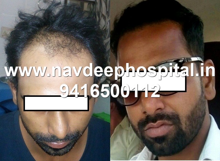 Before after FUE hair transplant at Navdeep Hospital and Laser center, Panipat, Haryana, India. best results