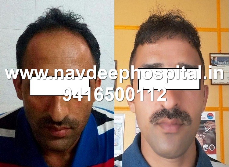 Before after FUE hair transplant results, Navdeep Hair transplant, Panipat, haryana, India.