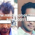 1 year after FUE hair transplant at Navdeep hair, Panipat, Haryana, India. Patient from Lucknow, UP