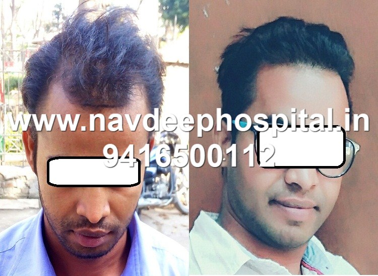 1 year after FUE hair transplant at Navdeep hair, Panipat, Haryana, India. Patient from Lucknow, UP