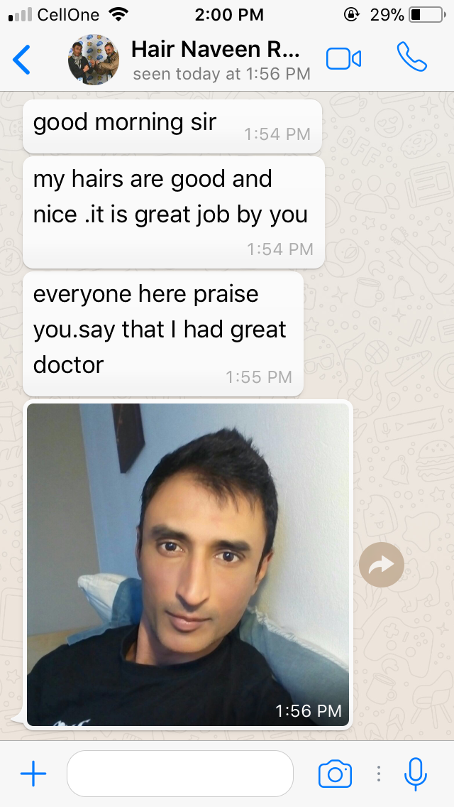 Result of FUE hair transplant comment, Patient from France, Done at Navdeep Hair transplant, panipat, Haryana, India.