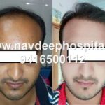 best result FUE hair transplant, Patient from Bhuj, Gujrat, at Navdeep hair transplant, Panipat, Haryana, India