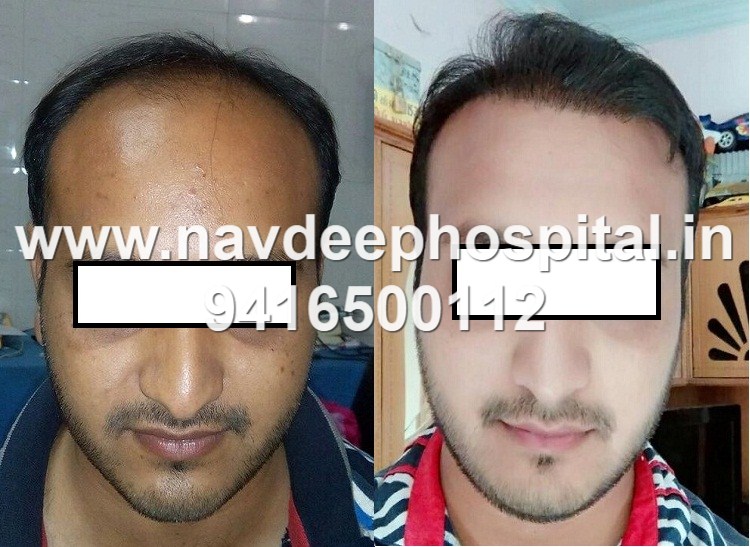 best result FUE hair transplant, Patient from Bhuj, Gujrat, at Navdeep hair transplant, Panipat, Haryana, India