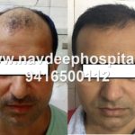 pictures of result of FUE hair transpalnt at Navdeep hair transplant, panipat, haryana, india 2