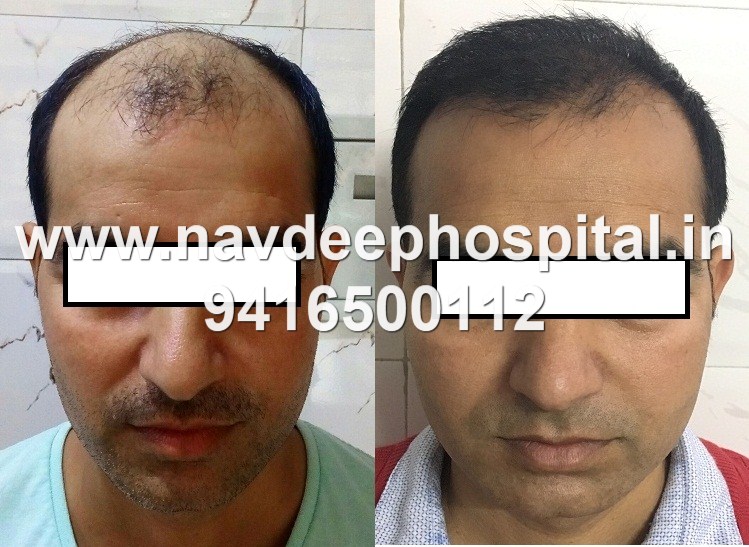 pictures of result of FUE hair transpalnt at Navdeep hair transplant, panipat, haryana, india 2