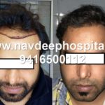 Comparison before after hair transplant at navdeep hospital, Panipat, Haryana, India. Mobile 9416500112