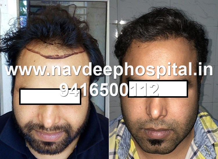 Comparison before after hair transplant at navdeep hospital, Panipat, Haryana, India. Mobile 9416500112