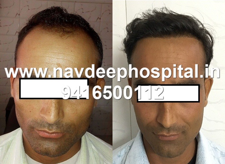 result of FUE hair transplant after 6 months. Client from Noida, at Navdeep hospital, Panipat, Haryana, India. Mobile 9416500112