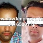 Best Results of hair transplant in India by FUE