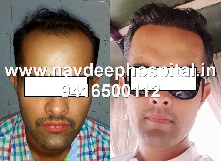 Best Results of hair transplant in India by FUE