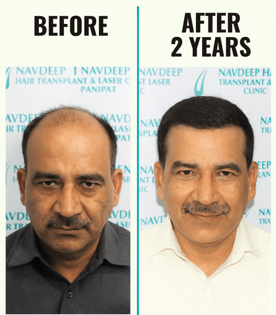 Real Results. Real Confidence. See the 2-Year Hair Transplant Journey at Navdeep Clinic!