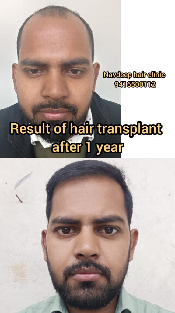 Before and after comparison of a successful hair transplant patient at Navdeep Hair transplant clinic in Panipat, showcasing dense and natural-looking hair growth one year after the procedure.