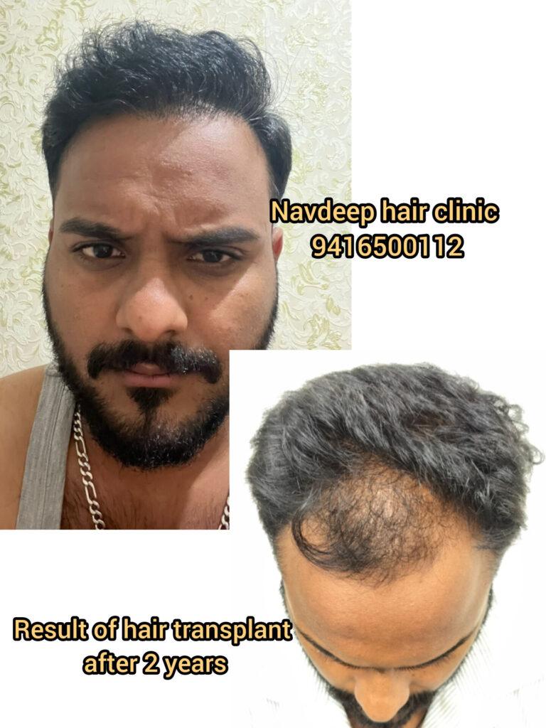 Frontal view of a male patient showing thick, natural hair growth 2 years after a hair transplant at Navdeep Hair Transplant Clinic in Panipat.